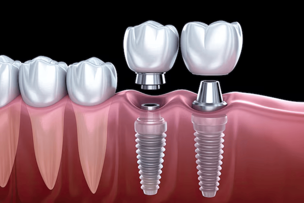Medical illustration showing the difference between a single tooth implant and an implant-supported bridge.